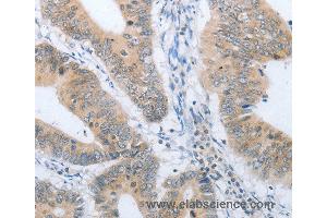 Immunohistochemistry of Human lung cancer using CHRNA10 Polyclonal Antibody at dilution of 1:50