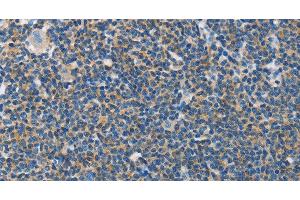 Immunohistochemistry of paraffin-embedded Human lymphoma tissue using NEK5 Polyclonal Antibody at dilution 1:60 (NEK5 Antikörper)