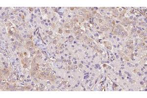 ABIN6273334 at 1/100 staining Human thyroid cancer tissue by IHC-P.