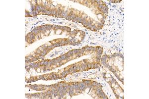 Immunohistochemistry of paraffin-embedded human colon carcinoma using eIF1A Rabbit mAb (ABIN7267027) at dilution of 1:50 (40x lens). (Eukaryotic Translation Initiation Factor 1A (EIF1A) Antikörper)