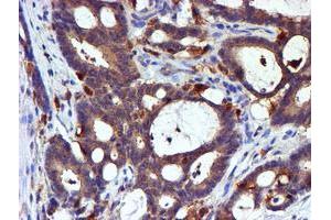 Immunohistochemical staining of paraffin-embedded Adenocarcinoma of Human colon tissue using anti-LIMK1 mouse monoclonal antibody. (LIM Domain Kinase 1 Antikörper)