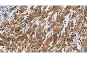 Immunohistochemistry of paraffin-embedded Human esophagus cancer tissue using DSP Polyclonal Antibody at dilution 1:40