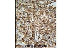 WDR43 Antibody (C-term) (ABIN651679 and ABIN2840356) immunohistochemistry analysis in formalin fixed and paraffin embedded human Cervix carcinoma followed by peroxidase conjugation of the secondary antibody and DAB staining. (WDR43 Antikörper  (C-Term))