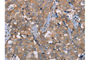 The image on the left is immunohistochemistry of paraffin-embedded Human breast cancer tissue using ABIN7191717(NRG3 Antibody) at dilution 1/30, on the right is treated with synthetic peptide. (Neuregulin 3 Antikörper)