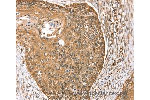 Immunohistochemistry of Human esophagus cancer using MORF4L1 Polyclonal Antibody at dilution of 1:35 (MORF4L1 Antikörper)