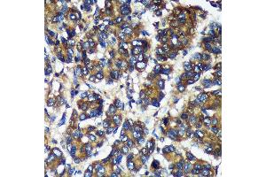 Immunohistochemistry of paraffin-embedded Human liver cancer using TMX2 Rabbit pAb (ABIN7270810) at dilution of 1:100 (40x lens). (TMX2 Antikörper  (AA 128-296))