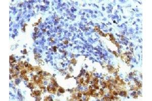 IHC testing of FFPE human lung adenocarcinoma with Napsin-A antibody (clone NPSNA-1). (NAPSA Antikörper)
