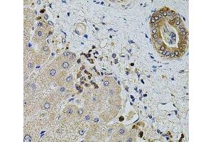 Immunohistochemistry of paraffin-embedded Human liver damage using KTN1 Polyclonal Antibody at dilution of 1:100 (40x lens).