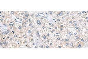 Immunohistochemistry of paraffin-embedded Human liver cancer tissue using ZNF35 Polyclonal Antibody at dilution of 1:40(x200) (ZNF35 Antikörper)