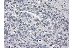 Immunohistochemical staining of paraffin-embedded Adenocarcinoma of breast tissue using anti-PPP5C mouse monoclonal antibody. (PP5 Antikörper)