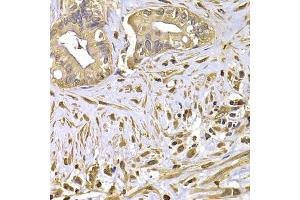 Immunohistochemistry of paraffin-embedded human liver cancer using FSCN1 antibody. (Fascin Antikörper)