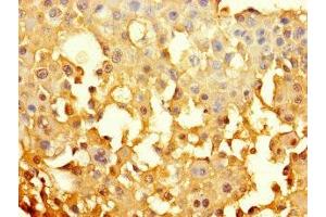 Immunohistochemistry of paraffin-embedded human breast cancer using ABIN7153625 at dilution of 1:100 (GJB6 Antikörper  (AA 216-261))
