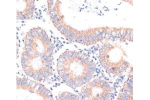Immunohistochemistry of paraffin-embedded Human colon carcinoma using EIF4EBP1 Polyclonal Antibody at dilution of 1:100 (40x lens). (eIF4EBP1 Antikörper)