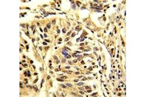 IHC analysis of FFPE human lung carcinoma stained with CEBPB antibody (CEBPB Antikörper  (AA 271-298))