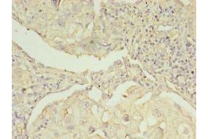 Immunohistochemistry of paraffin-embedded human lung cancer using ABIN7142288 at dilution of 1:100 (EBP Antikörper  (AA 2-230))