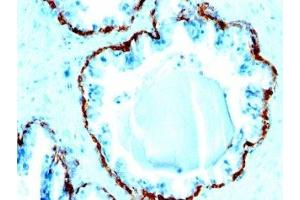 Formalin-fixed, paraffin-embedded human prostate carcinoma stained with Basic Cytokeratin antibody (SPM591). (Keratin Basic Antikörper)