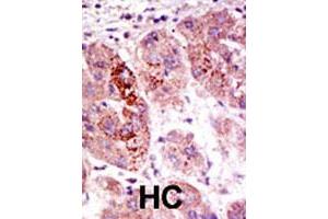 Formalin-fixed and paraffin-embedded human hepatocellular carcinoma tissue reacted with the USP7 polyclonal antibody  , which was peroxidase-conjugated to the secondary antibody, followed by AEC staining . (USP7 Antikörper  (C-Term))