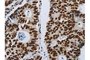 The image on the left is immunohistochemistry of paraffin-embedded Human colon cancer tissue using ABIN7192399(SLC16A14 Antibody) at dilution 1/80, on the right is treated with synthetic peptide. (SLC16A14 Antikörper)