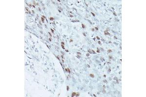 Immunohistochemistry of paraffin-embedded human breast cancer using MEF2C antibody (ABIN3023393, ABIN3023394, ABIN3023395 and ABIN6219695) at dilution of 1:100 (40x lens). (MEF2C Antikörper  (AA 170-380))