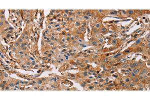 Immunohistochemistry of paraffin-embedded Human lung cancer using ACTA1 Polyclonal Antibody at dilution of 1:65 (Actin Antikörper)