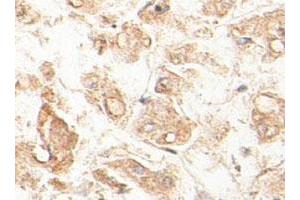 Immunohistochemical staining of formalin-fixed paraffin-embedded human fetal liver tissue showing cytoplasmic staining with ACAA1 polyclonal antibody  at 1 : 100 dilution.