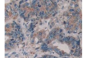 Detection of PDIA4 in Human Colorectal cancer Tissue using Polyclonal Antibody to Protein Disulfide Isomerase A4 (PDIA4)