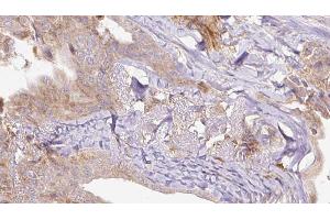 ABIN6273305 at 1/100 staining Human thyroid cancer tissue by IHC-P. (RAB3A Antikörper  (N-Term))