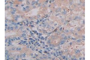 IHC-P analysis of Human Stomach cancer Tissue, with DAB staining. (CTSC Antikörper  (AA 231-463))