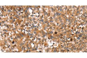 Immunohistochemistry of paraffin-embedded Human lung cancer using STAR Polyclonal Antibody at dilution of 1:35 (STAR Antikörper)