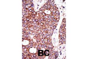 Formalin-fixed and paraffin-embedded human cancer tissue reacted with GCNT1 polyclonal antibody  , which was peroxidase-conjugated to the secondary antibody, followed by DAB staining .