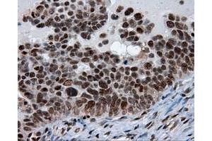 Immunohistochemical staining of paraffin-embedded Adenocarcinoma of breast tissue using anti-SIL1 mouse monoclonal antibody.