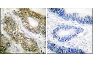 Immunohistochemistry analysis of paraffin-embedded human colon carcinoma tissue, using SEPARASE (Ab-801) Antibody.