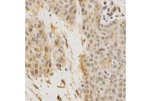 Immunohistochemistry of paraffin-embedded human esophageal cancer using GGA2 Antibody. (GGA2 Antikörper)