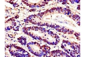 Immunohistochemistry of paraffin-embedded human colon cancer using ABIN7168587 at dilution of 1:100 (SPDEF/PSE Antikörper  (AA 145-247))