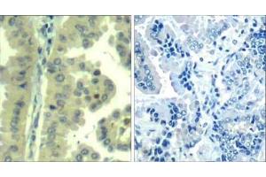 Immunohistochemical analysis of paraffin-embedded human lung carcinoma tissue using eIF4G (Ab-1232) Antibody (E021514). (EIF4G1 Antikörper)