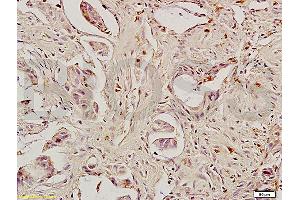 Formalin-fixed and paraffin embedded human rectal carcinoma labeled with Anti-Caspase-8 Polyclonal Antibody, Unconjugated (ABIN724205) 1:200 followed by conjugation to the secondary antibody and DAB staining (Caspase 8 Antikörper  (AA 411-482))