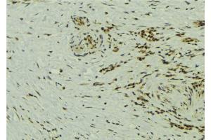 ABIN6273240 at 1/100 staining Human breast cancer tissue by IHC-P. (ETV5 Antikörper  (Internal Region))