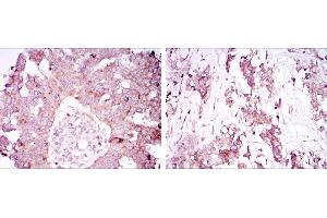Immunohistochemical analysis of paraffin-embedded ovarian cancer tissues (left) and lung cancer tissues (right) using ATXN1 mouse mAb with DAB staining. (Ataxin 1 Antikörper)