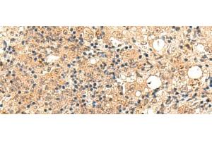 Immunohistochemistry of paraffin-embedded Human esophagus cancer tissue using ZFYVE27 Polyclonal Antibody at dilution of 1:50(x200) (ZFYVE27 Antikörper)