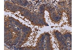 The image on the left is immunohistochemistry of paraffin-embedded Human colon cancer tissue using ABIN7130206(MCTS1 Antibody) at dilution 1/30, on the right is treated with fusion protein. (MCTS1 Antikörper)