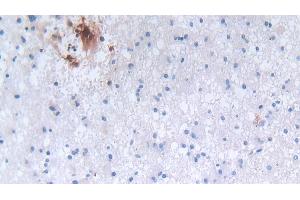 Detection of DEFa3 in Human Glioma Tissue using Polyclonal Antibody to Defensin Alpha 3, Neutrophil Specific (DEFa3) (DEFa3 Antikörper  (AA 21-94))