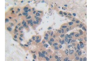 IHC-P analysis of Human Breast cancer Tissue, with DAB staining. (CSN2 Antikörper  (AA 41-198))