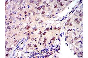 Immunohistochemical analysis of paraffin-embedded lung cancer tissues using MCM2 mouse mAb with DAB staining. (MCM2 Antikörper)