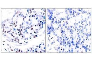 Immunohistochemical analysis of paraffin-embedded human breast carcinoma tissue using c-Jun (Ab-239) antibody (E021024). (C-JUN Antikörper)