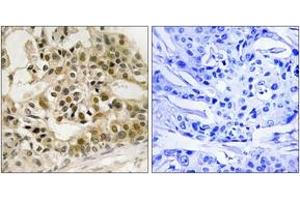 Immunohistochemistry analysis of paraffin-embedded human breast carcinoma, using Myb (Phospho-Ser532) Antibody. (MYB Antikörper  (pSer532))