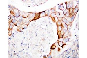 IHC-P: CD18 antibody testing of human breast cancer tissue