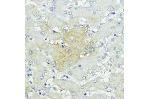 Immunohistochemistry of paraffin-embedded human liver cancer using SOCS5 antibody (ABIN6128734, ABIN6148271, ABIN6148272 and ABIN6223959) at dilution of 1:100 (40x lens).