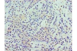Immunohistochemistry of paraffin-embedded human breast cancer using ABIN7169685 at dilution of 1:100 (STAT5B Antikörper  (AA 40-280))