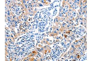 The image on the left is immunohistochemistry of paraffin-embedded Human lung cancer tissue using ABIN7128221(ACYP1 Antibody) at dilution 1/25, on the right is treated with fusion protein.