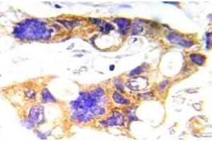 Immunohistochemistry (IHC) analyzes of p-c-RAF antibody in paraffin-embedded human prostate carcinoma tissue. (NCOA1 Antikörper  (pTyr529))